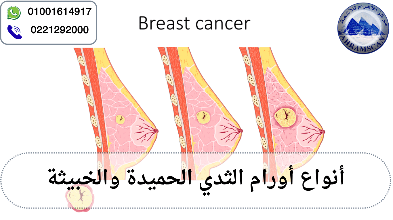 أنواع أورام الثدي الحميدة والخبيثة