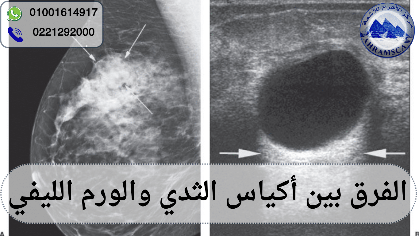 الفرق بين أكياس الثدي والورم الليفي
