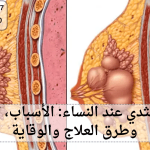 امراض الثدي عند النساء