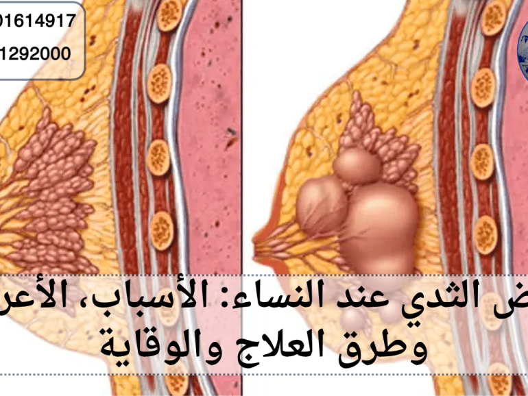 امراض الثدي عند النساء
