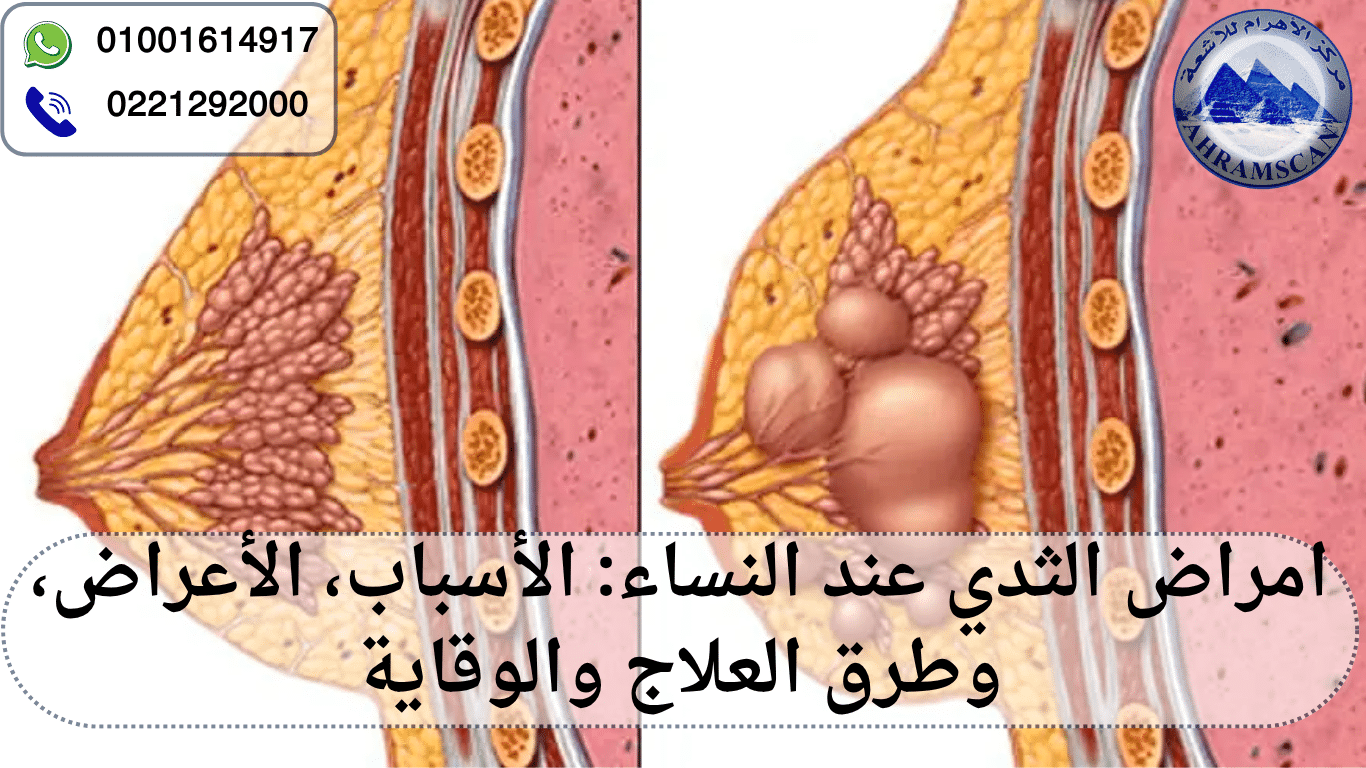 امراض الثدي عند النساء