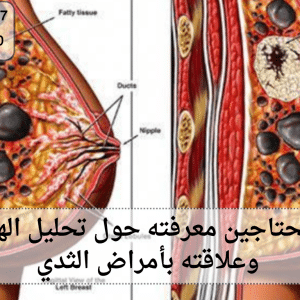 تحليل الهرمونات وعلاقته بأمراض الثدي