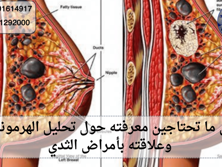 تحليل الهرمونات وعلاقته بأمراض الثدي