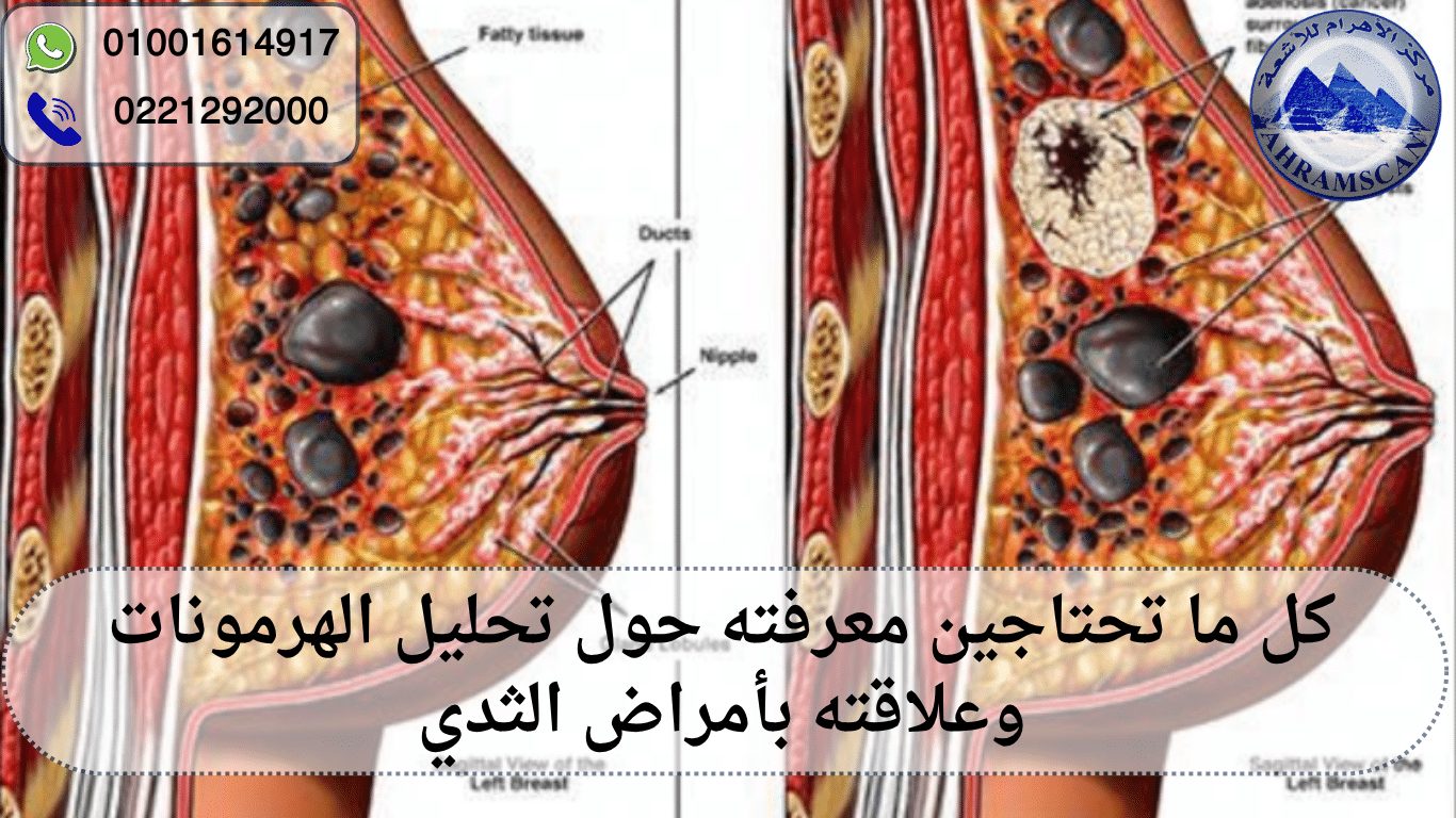 تحليل الهرمونات وعلاقته بأمراض الثدي