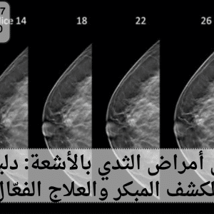 تشخيص أمراض الثدي بالأشعة