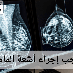متى يجب إجراء أشعة الماموجرام