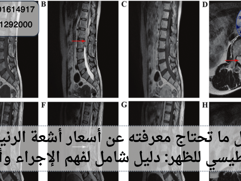 أسعار أشعة الرنين المغناطيسي للظهر