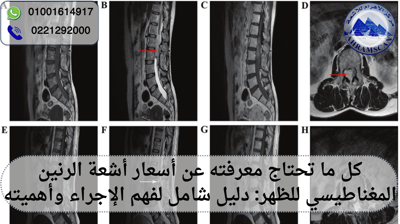 أسعار أشعة الرنين المغناطيسي للظهر