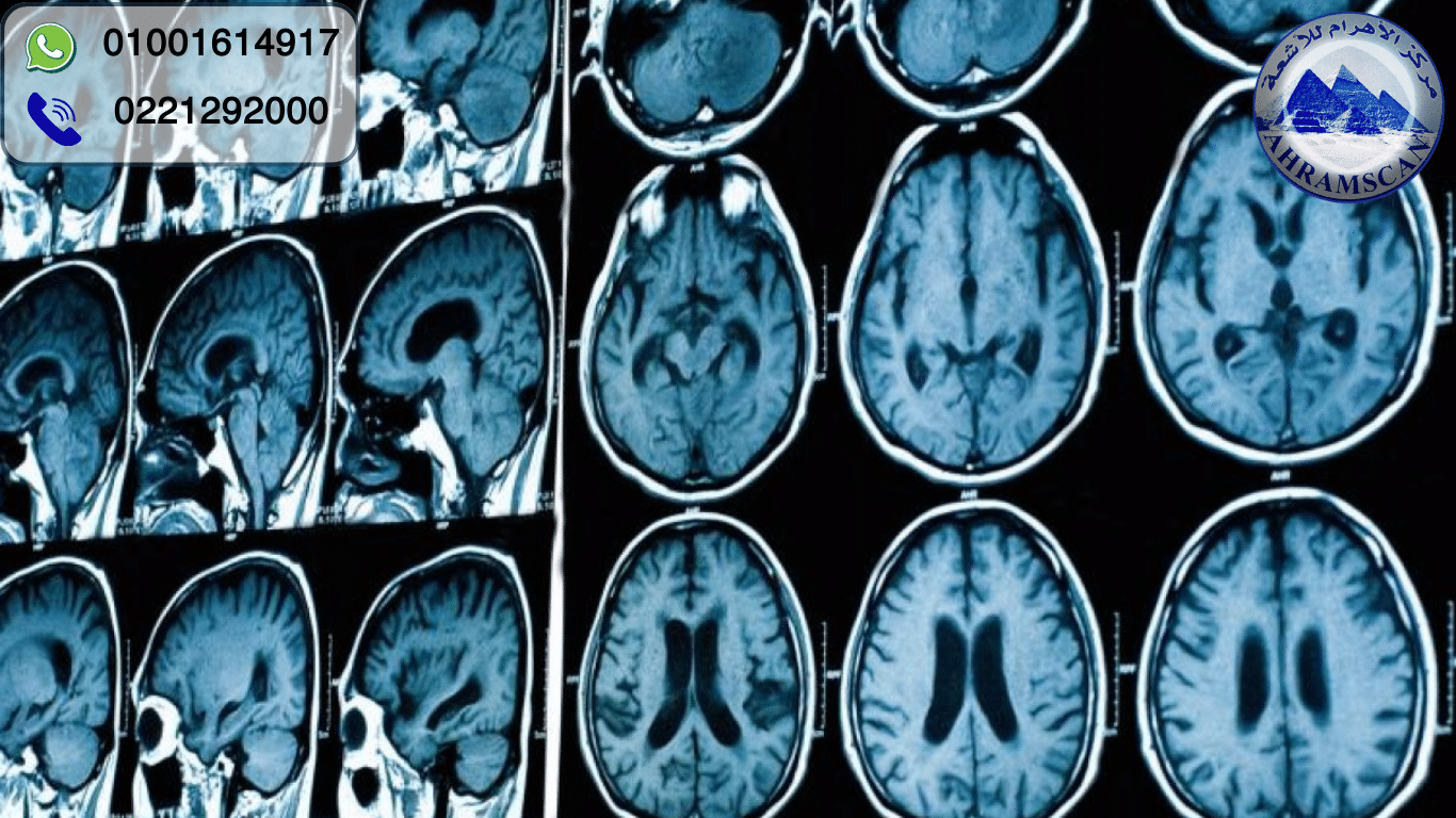 كيفية قراءة أشعة الرنين المغناطيسي للمخ