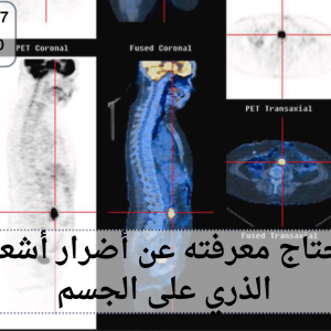 أضرار أشعة المسح الذري على الجسم